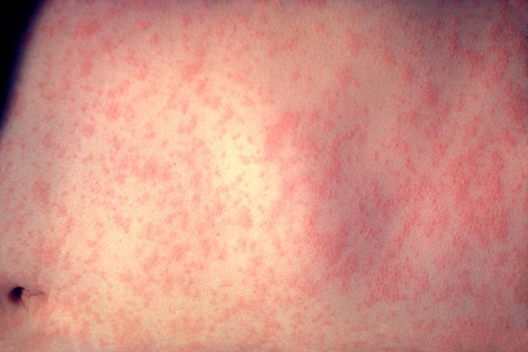 Increase in measles cases in Vancouver prompts requests for vaccinations elsewhere