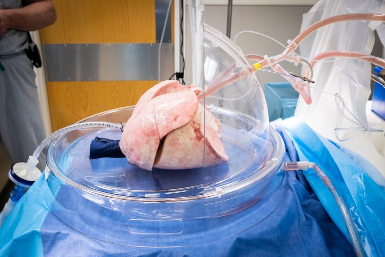 More Lung Transplants Becoming a Reality